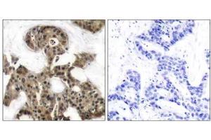 Immunohistochemical analysis of paraffin-embedded human breast carcinoma tissue using 4E-BP1 (Ab-45) antibody (E021216). (eIF4EBP1 Antikörper)