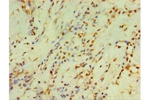 Immunohistochemistry of paraffin-embedded human breast cancer using ABIN7149253 at dilution of 1:100 (CYP2J2 Antikörper  (AA 328-502))