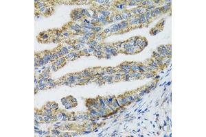Immunohistochemistry of paraffin-embedded human gastric cancer using TXN2 antibody (ABIN2560616) at dilution of 1:100 (40x lens). (TXN2 Antikörper)