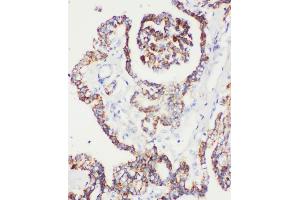 Anti-Peroxiredoxin 5 antibody, IHC(P) IHC(P): Human Prostatic Cancer Tissue (Peroxiredoxin 5 Antikörper  (C-Term))
