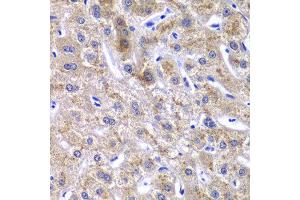 Immunohistochemistry of paraffin-embedded human liver injury using GOLM1 antibody at dilution of 1:100 (x40 lens).