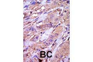 Formalin-fixed and paraffin-embedded human cancer tissue reacted with the primary antibody, which was peroxidase-conjugated to the secondary antibody, followed by DAB staining. (CK1 epsilon Antikörper  (C-Term))