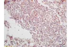 Formalin-fixed and paraffin embedded human lung carcinoma labeled with Rabbit Anti Histone H3-like protein Polyclonal Antibody, Unconjugated (ABIN670986) at 1:200 followed by conjugation to the secondary antibody and DAB staining (Centromeric Histone H3-Like Protein-2 (AA 51-145) Antikörper)
