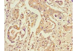 Immunohistochemistry of paraffin-embedded human pancreatic cancer using ABIN7150603 at dilution of 1:100 (STT3A Antikörper  (AA 39-114))