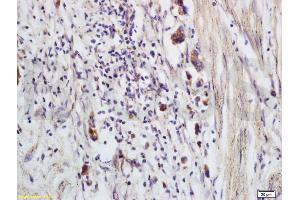 Formalin-fixed and paraffin embedded human colon carcinoma labeled with Anti-CCP Polyclonal Antibody, Unconjugated (ABIN736971) at 1:200 followed by conjugation to the secondary antibody and DAB staining