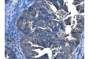 IHC-P Image CCDC83 antibody [N1C2] detects CCDC83 protein at cytoplasm and nucleus in human endometrial cancer by immunohistochemical analysis. (CCDC83 Antikörper)