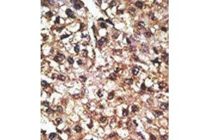 Formalin-fixed and paraffin-embedded human cancer tissue reacted with the primary antibody, which was peroxidase-conjugated to the secondary antibody, followed by AEC staining. (PINK1 Antikörper  (N-Term))