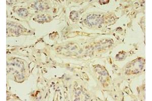 Immunohistochemistry of paraffin-embedded human breast cancer using ABIN7176199 at dilution of 1:100 (ZNF266 Antikörper  (AA 257-549))