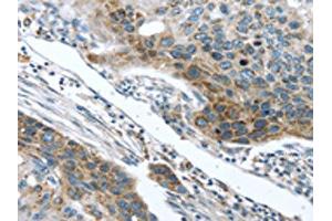 The image on the left is immunohistochemistry of paraffin-embedded Human esophagus cancer tissue using ABIN7131406(TMPRSS5 Antibody) at dilution 1/25, on the right is treated with fusion protein. (TMPRSS5 Antikörper)