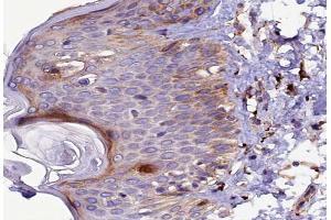 ABIN6267491 at 1/100 staining human Skin cancer tissue sections by IHC-P. (VEGFR2/CD309 Antikörper  (pTyr1214))