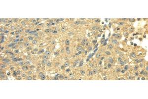 Immunohistochemistry of paraffin-embedded Human breast cancer using SDHA Polyclonal Antibody at dilution of 1/40 (SDHA Antikörper)