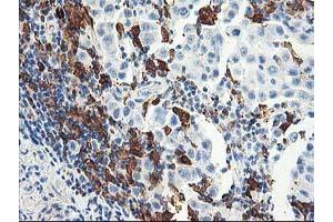 Immunohistochemical staining of paraffin-embedded Carcinoma of Human lung tissue using anti-GBP1 mouse monoclonal antibody.