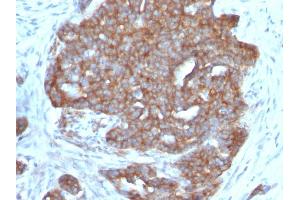 Formalin-fixed, paraffin-embedded human Ovarian Carcinoma stained with pS2 Monoclonal Antibody (SPM313). (TFF1 Antikörper  (AA 57-84))