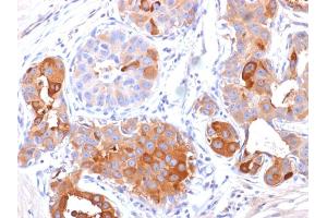 Formalin-fixed, paraffin-embedded human Breast Carcinoma stained with GCDFP-15 Mouse Monoclonal Antibody (PIP/1571).