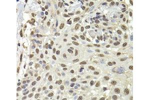 Immunohistochemistry of paraffin-embedded Human well-differentiated squamous skin carcinoma using PUF60 Polyclonal Antibody at dilution of 1:100 (40x lens). (PUF60 Antikörper)