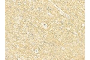 ABIN6262899 and ABIN6273003 at 1/100 staining human glioblastoma by IHC-P. (L2HGDH Antikörper  (Internal Region))