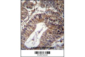 GCC1 Antibody immunohistochemistry analysis in formalin fixed and paraffin embedded human colon carcinoma followed by peroxidase conjugation of the secondary antibody and DAB staining. (GCC1 Antikörper  (C-Term))