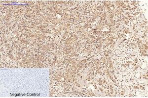 Immunohistochemical analysis of paraffin-embedded human breast cancer tissue. (MLKL Antikörper  (pSer358))