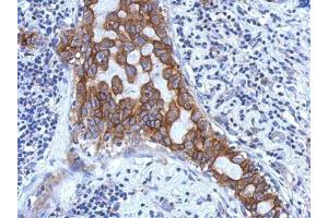 IHC-P Image Immunohistochemical analysis of paraffin-embedded human breast cancer, using IL1RAP, antibody at 1:500 dilution. (IL1RAP Antikörper)