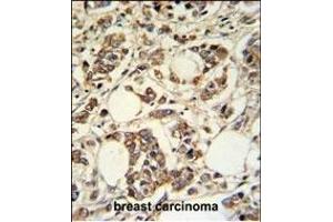 PIGM Antibody (C-term) (ABIN650949 and ABIN2840006) IHC analysis in formalin fixed and paraffin embedded breast carcinoma followed by peroxidase conjugation of the secondary antibody and DAB staining. (PIGM Antikörper  (C-Term))