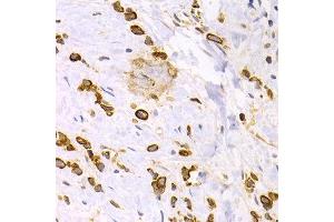 Immunohistochemistry of paraffin-embedded human stomach cancer using KRT15 antibody at dilution of 1:200 (400x lens).
