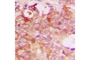 Immunohistochemical analysis of PIG3 staining in human breast cancer formalin fixed paraffin embedded tissue section. (MRPL41 Antikörper  (C-Term))