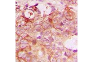 Immunohistochemical analysis of PIG3 staining in human breast cancer formalin fixed paraffin embedded tissue section.