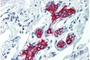 Human Breast (formalin-fixed, paraffin-embedded) stained with KRT19 antibody ABIN396943 at 10 ug/ml followed by biotinylated anti-mouse IgG secondary antibody ABIN481714, alkaline phosphatase-streptavidin and chromogen. (Cytokeratin 19 Antikörper)