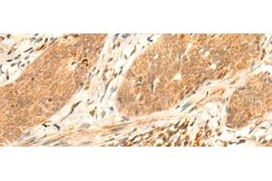 Immunohistochemistry of paraffin-embedded Human esophagus cancer tissue using HES7 Polyclonal Antibody at dilution of 1:25(x200) (HES7 Antikörper)