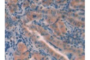 Detection of CTSL in Human Thyroid cancer Tissue using Polyclonal Antibody to Cathepsin L (CTSL) (Cathepsin L Antikörper  (AA 114-288))