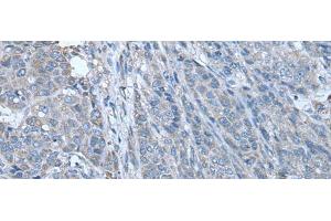 Immunohistochemistry of paraffin-embedded Human liver cancer tissue using ZC3HAV1 Polyclonal Antibody at dilution of 1:70(x200) (ZC3HAV1 Antikörper)