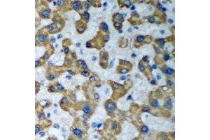 Immunohistochemical analysis of HADHA staining in human liver cancer formalin fixed paraffin embedded tissue section. (HADHA Antikörper)