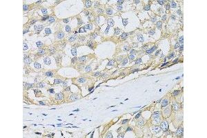 Immunohistochemistry of paraffin-embedded Human breast cancer using CD98 Polyclonal Antibody at dilution of 1:100 (40x lens). (SLC3A2 Antikörper)