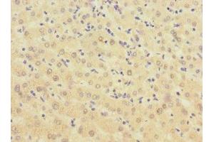 Immunohistochemistry of paraffin-embedded human liver cancer using ABIN7145876 at dilution of 1:100