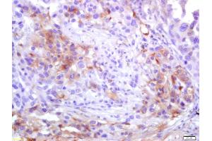 Formalin-fixed and paraffin embedded human lung carcinoma labeled with Anti-ADAM10 Polyclonal Antibody, Unconjugated (ABIN701020) at 1:200 followed by conjugation to the secondary antibody and DAB staining