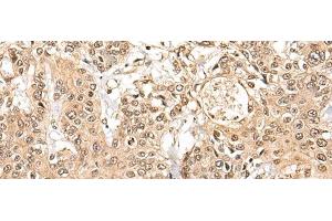 Immunohistochemistry of paraffin-embedded Human prost ate cancer tissue using NCAPH Polyclonal Antibody at dilution of 1:45(x200) (NCAPH Antikörper)