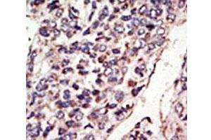 IHC analysis of FFPE human hepatocarcinoma tissue stained with the TRKC antibody
