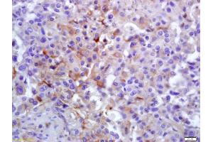 Formalin-fixed and paraffin embedded human lung carcinoma labeled with Anti-PLK1 Polyclonal Antibody, Unconjugated (ABIN700435) at 1:200 followed by conjugation to the secondary antibody and DAB staining (PLK1 Antikörper  (AA 201-300))
