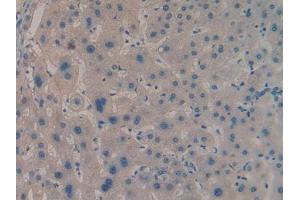 DAB staining on IHC-P; Samples: Human Liver cancer Tissue (IGF2BP2 Antikörper  (AA 141-384))