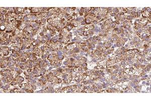 ABIN6272675 at 1/100 staining Human liver cancer tissue by IHC-P. (BAI2 Antikörper  (C-Term))
