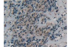 Detection of DbH in Human Breast cancer Tissue using Polyclonal Antibody to Dopamine Beta Hydroxylase (DbH) (DBH Antikörper  (AA 335-571))