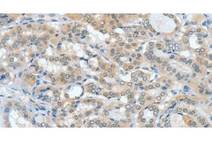 Immunohistochemistry of paraffin-embedded Human thyroid cancer tissue using ASH2L Polyclonal Antibody at dilution 1:60 (ASH2L Antikörper)