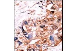 Formalin-fixed and paraffin-embedded human cancer tissue reacted with the primary antibody, which was peroxidase-conjugated to the secondary antibody, followed by AEC staining. (YES1/SRC (pTyr530) Antikörper)