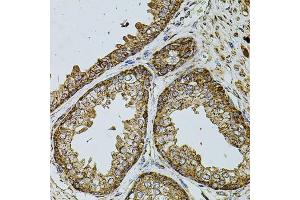 Immunohistochemistry of paraffin-embedded human prostate using UQCRC1 antibody (ABIN5971722) at dilution of 1/100 (40x lens). (UQCRC1 Antikörper)