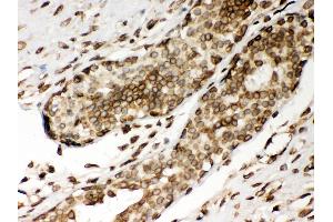 Anti- Lamin A Picoband antibody, IHC(P) IHC(P): Human Mammary Cancer Tissue (Lamin A/C Antikörper  (AA 481-646))