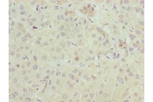 Immunohistochemistry of paraffin-embedded human liver cancer using ABIN7151560 at dilution of 1:100 (ELOVL2 Antikörper  (AA 91-174))