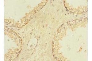 Immunohistochemistry of paraffin-embedded human prostate cancer using ABIN7175634 at dilution of 1:100 (VN1R5 Antikörper  (AA 185-269))