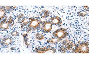 Immunohistochemistry of paraffin-embedded Human stomach cancer using Claudin 7 Polyclonal Antibody at dilution of 1:50 (Claudin 7 Antikörper)