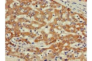 Immunohistochemistry of paraffin-embedded human liver cancer using ABIN7163167 at dilution of 1:100 (PIK3R2 Antikörper  (Regulatory Subunit beta))