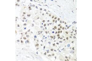 Immunohistochemistry of paraffin-embedded human lung cancer using TRMT1 antibody. (TRMT1 Antikörper)